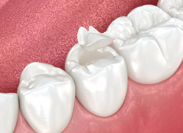 Dental Inlays and Onlays in Island Lake, IL